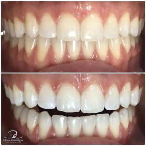 clareamento dental