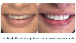 facetas de resina