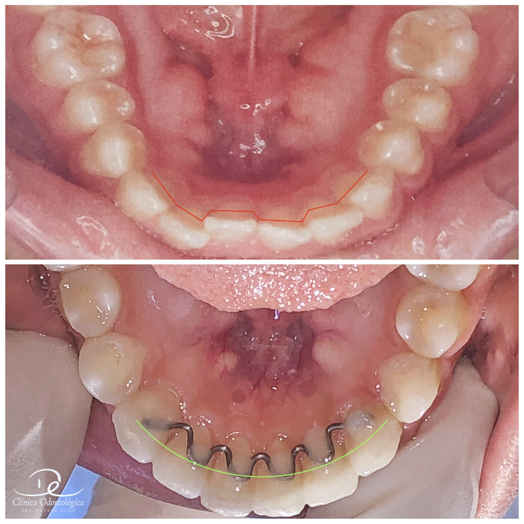 Antes e depois de tratamento ortodôntico