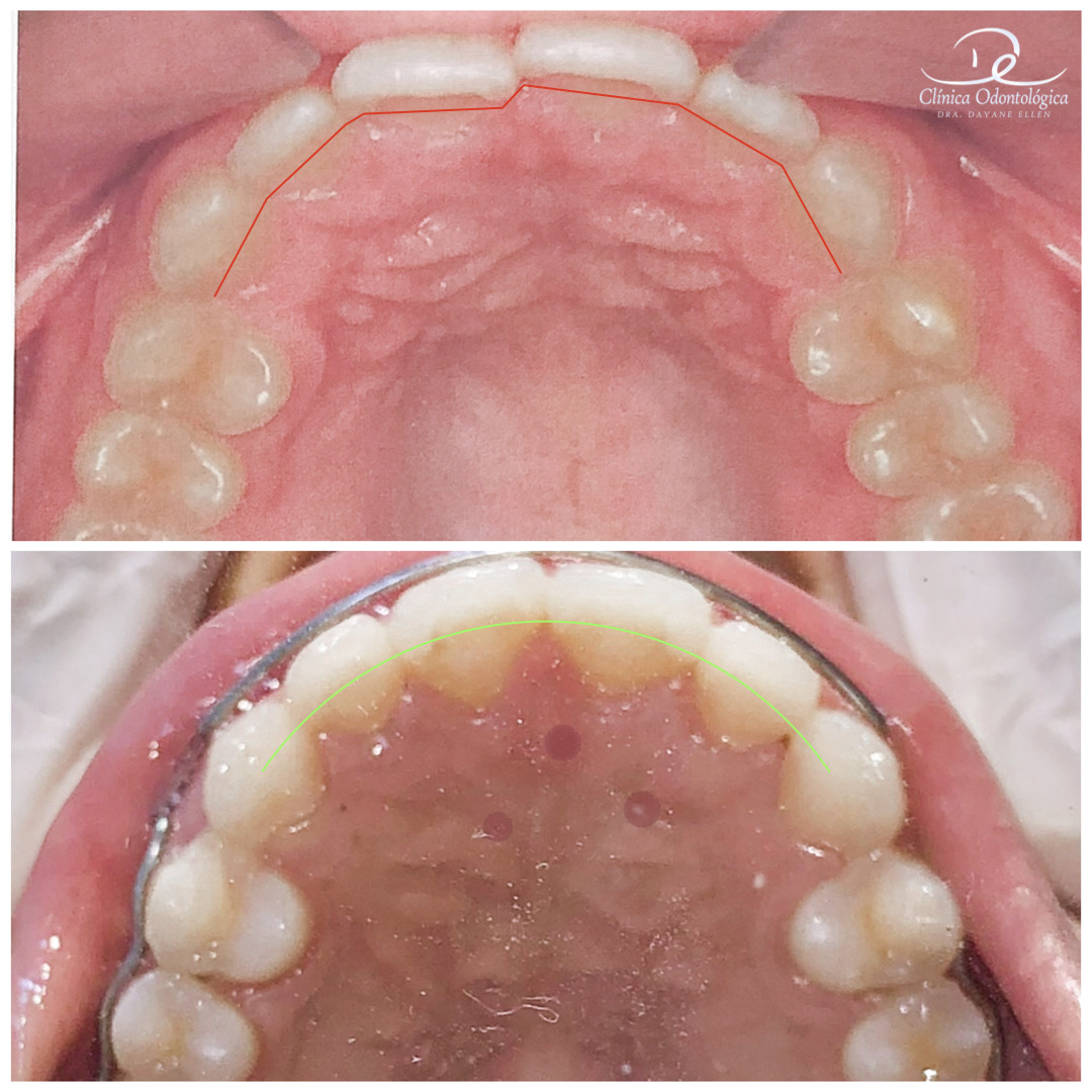 Antes e depois de tratamento ortodôntico