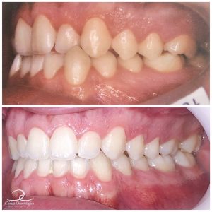 Antes e depois de tratamento ortodôntico