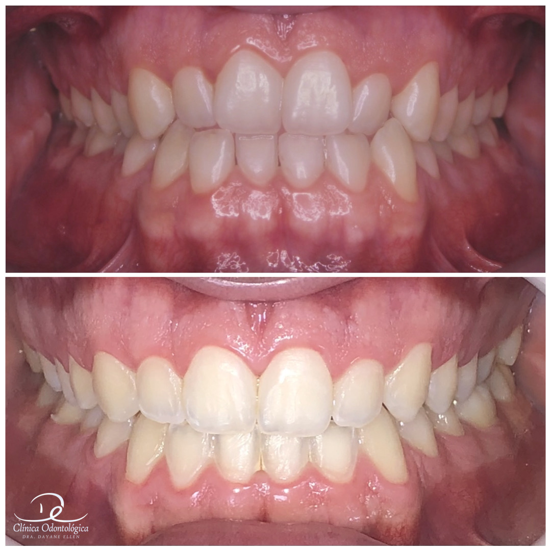 Antes e depois de tratamento ortodôntico