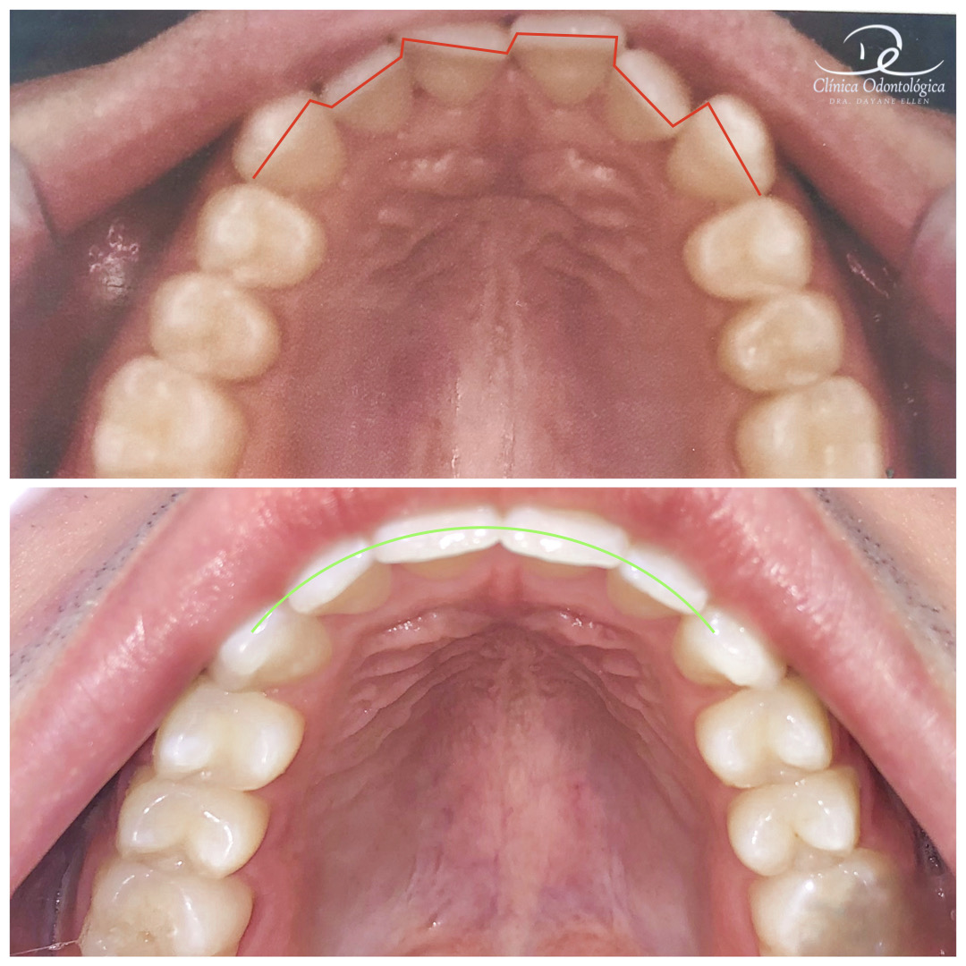Antes e depois de tratamento ortodôntico