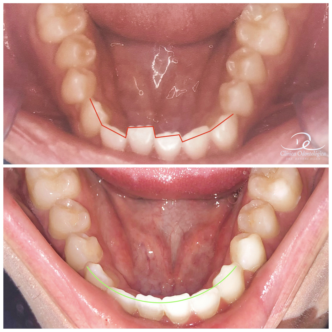 Antes e depois de tratamento ortodôntico