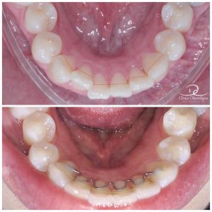 Antes e depois de tratamento ortodôntico