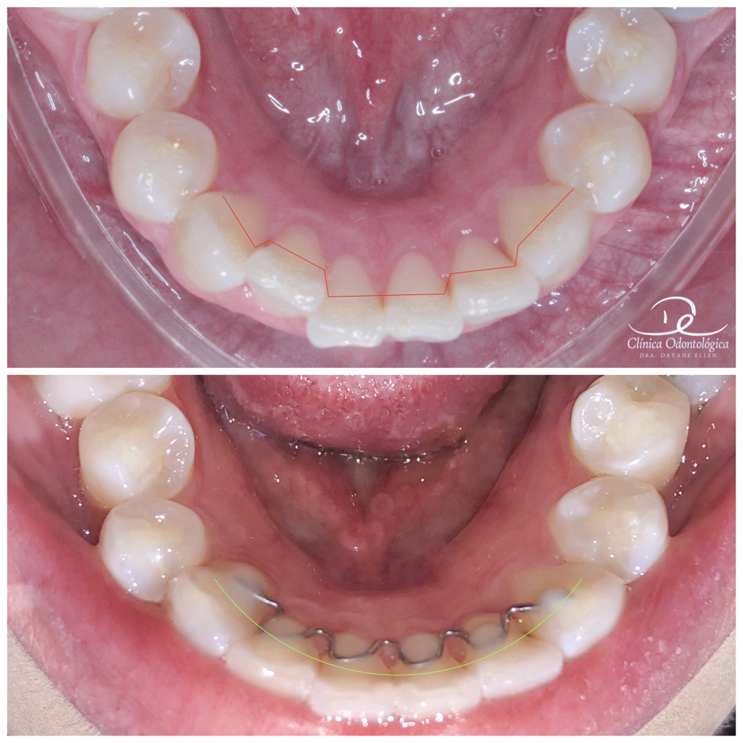 Antes e depois de tratamento ortodôntico