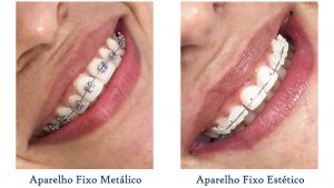 tratamento ortodontico