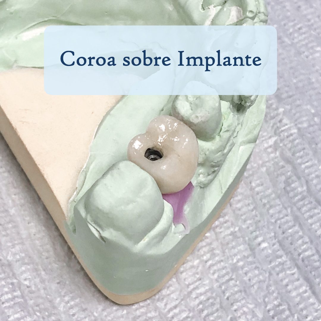 implantes dentários