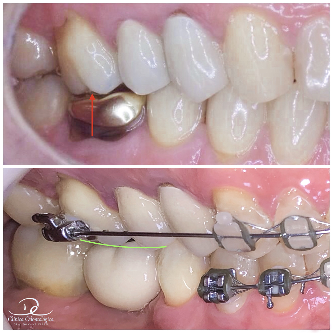 implantes dentários