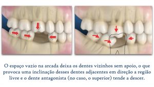 implantes dentários